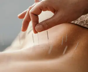 acupuncture